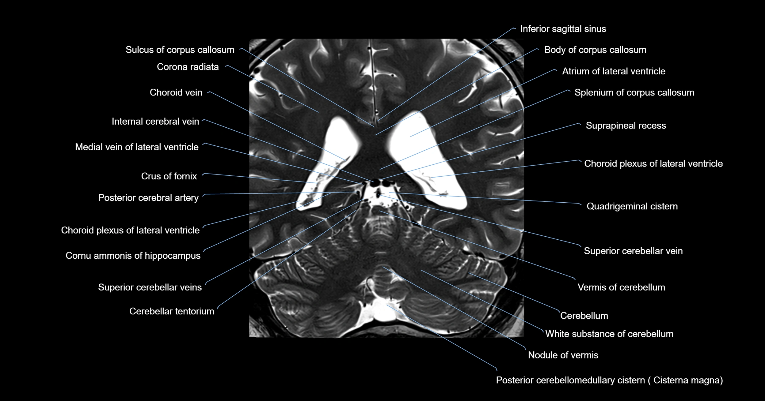 MRI brainstem & basal ganglia anatomy labelled 3T MRI images -img-00001-00034.webp